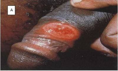 Patterns of STIs, panel A