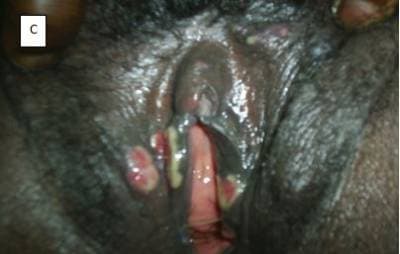 Patterns of STIs, panel C — herpetic labial ulcers
