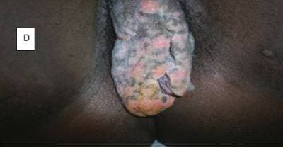 Patterns of STIs, panel D — genital warts